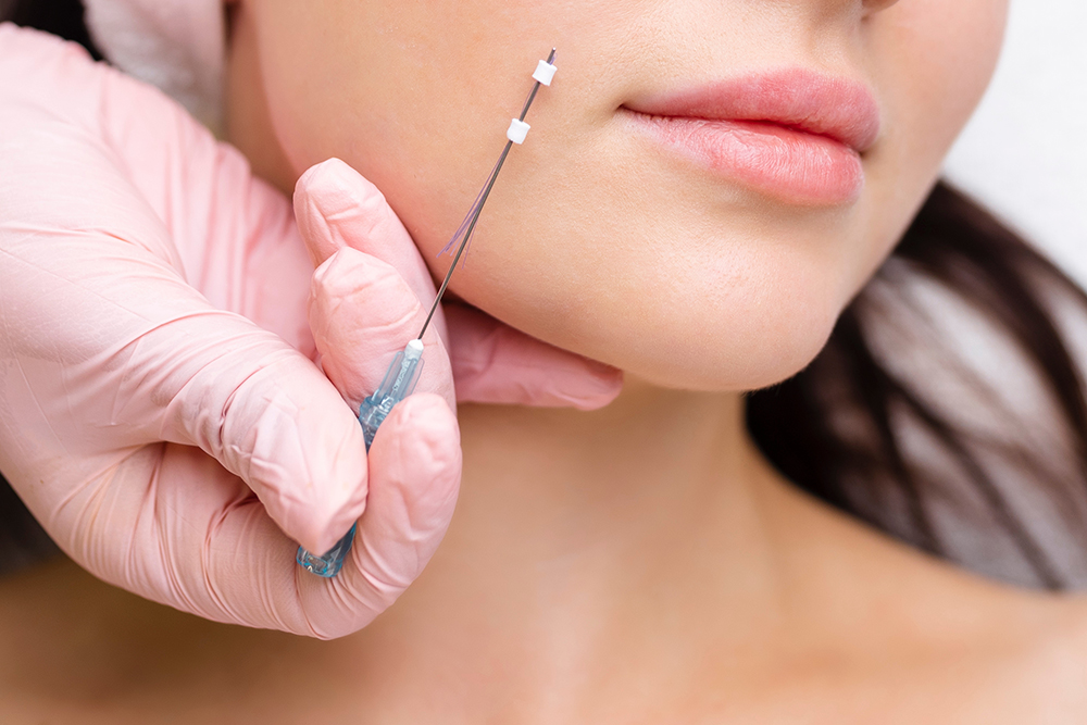 Professional microneedling treatment at Alicia Beauty in Tooting